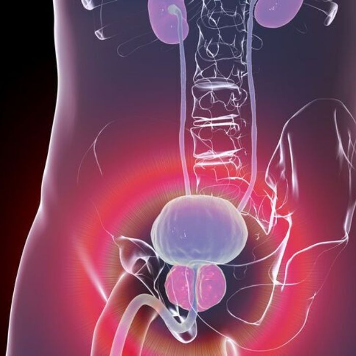 Les premiers signes du cancer de la prostate