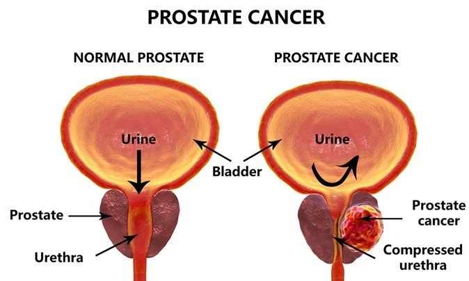 Prostate normale Vs prostate atteinte de cancer