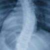 Amyotrophie spinale - cliché radiographique